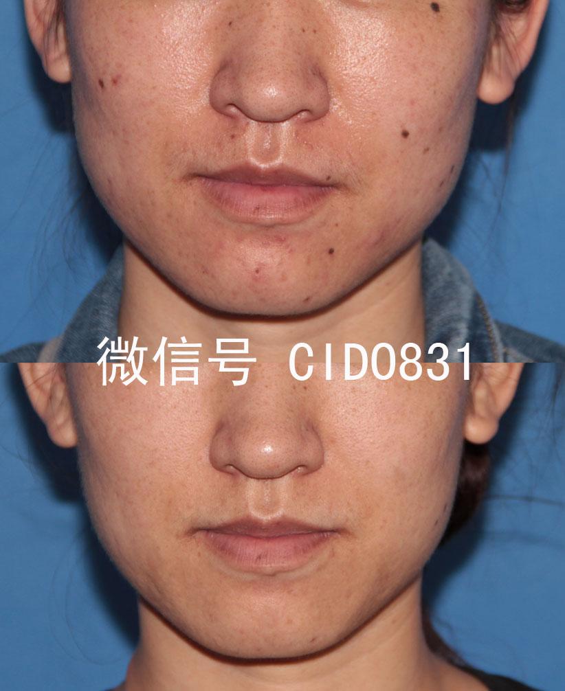 激光祛痘印皮肤会变薄吗?会有副作用吗? - 刘医