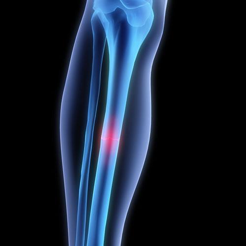 小腿疼痛如何破——胫骨内侧应力综合征浅析之三