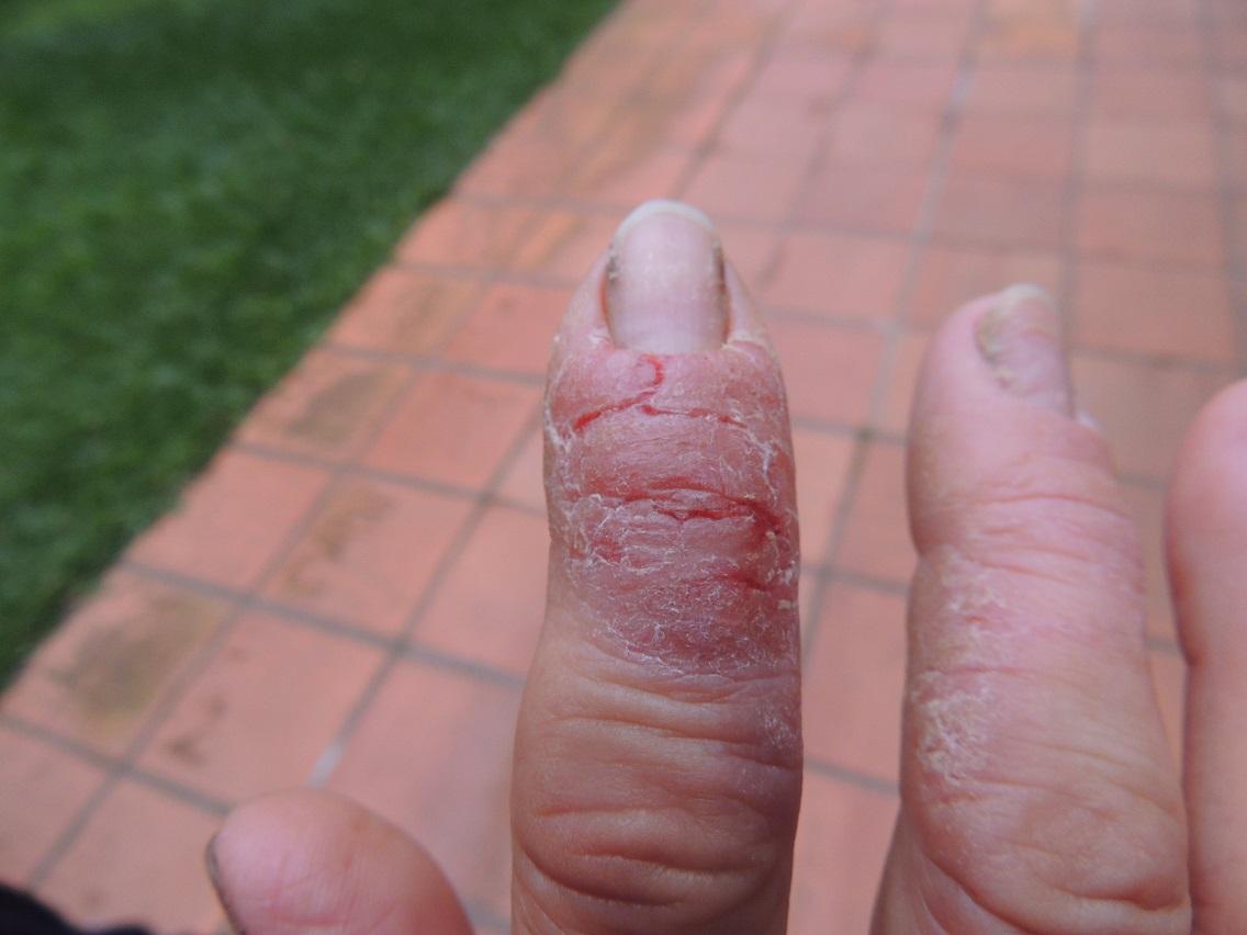 手指皮肤皲裂如何治?