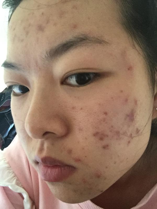 hallo 因为控制不住自己的嘴,开始了第五次长痘 这次好严重,全脸都长