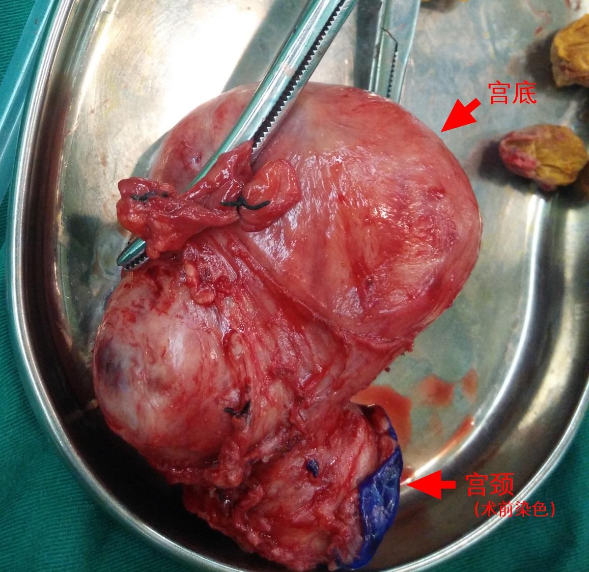 这是一个长了肌瘤的子宫,颜色和健康子宫是一样的. 2.卵巢
