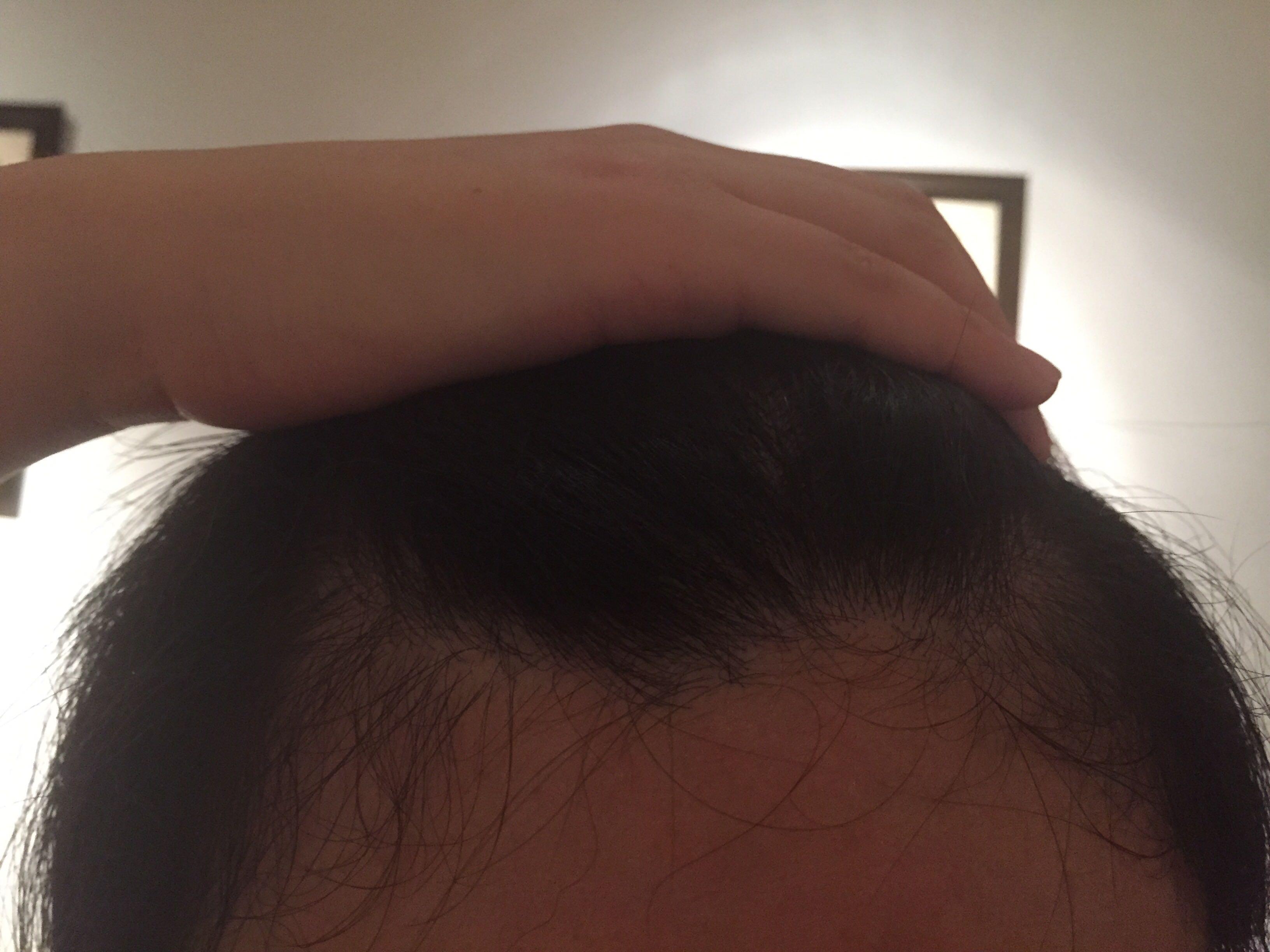 发际线两边<em>头发又</em>软<em>又卷</em>,还总往中间跑,是有两