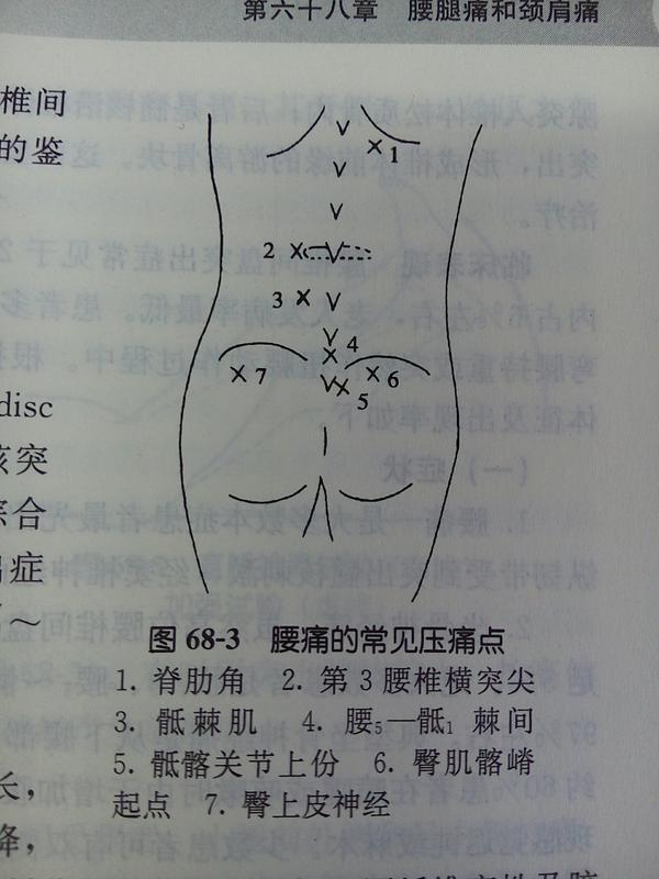 腰肌劳损的压痛点到底是什么?