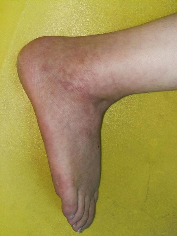 我右脚外侧脚踝扭伤已5个月,如今还有红色淤血,是什么