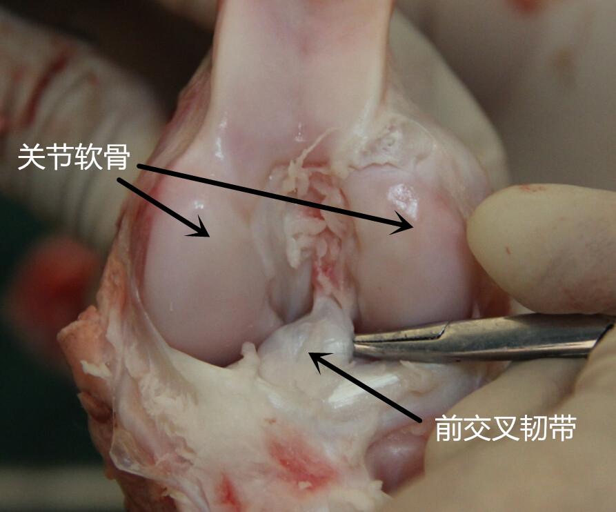 mri显示半月板撕裂,但抽屉实验没有症状是否手术?