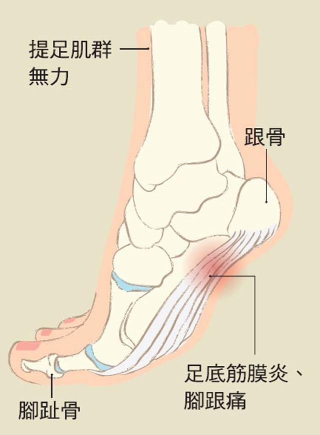 这是一种意外的脚踝韧带拉抻或撕裂.崴脚时容易导致扭伤.