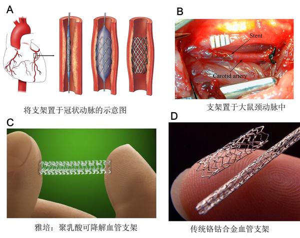 《新英格兰医学杂志:可降解的冠状动脉支架