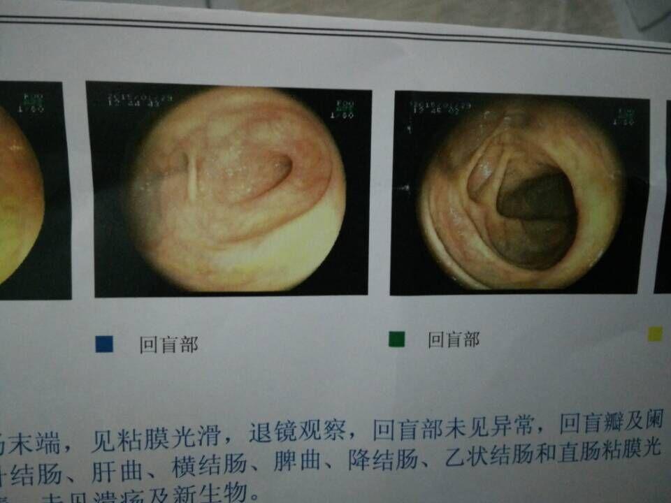 回肠末端黑色泡沫物质是什么 意味着什么?