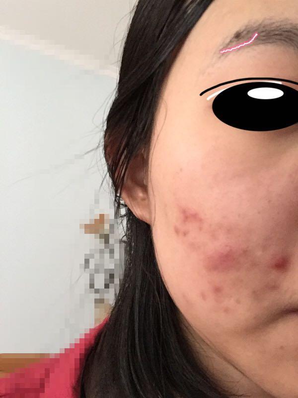 本人女生脸上长很多痘,?-王山而的回答女生拽qq超拽网名图片