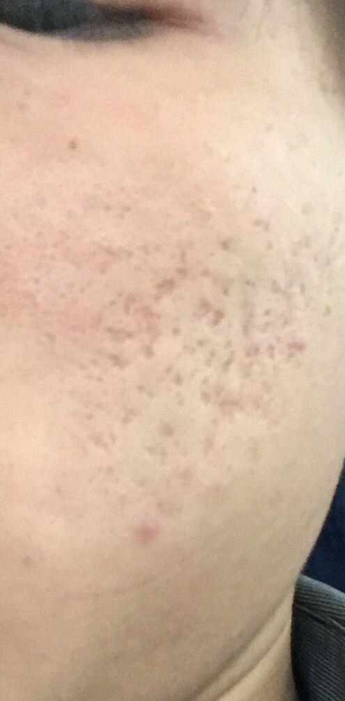 要去痘坑只有激光才有效吗?