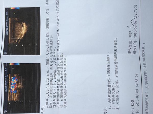 我这个精索静脉曲张严重吗?