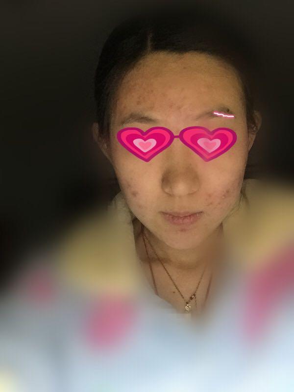 本人政治脸上长很多痘,?-王山而的回答初二女生男生女生图片