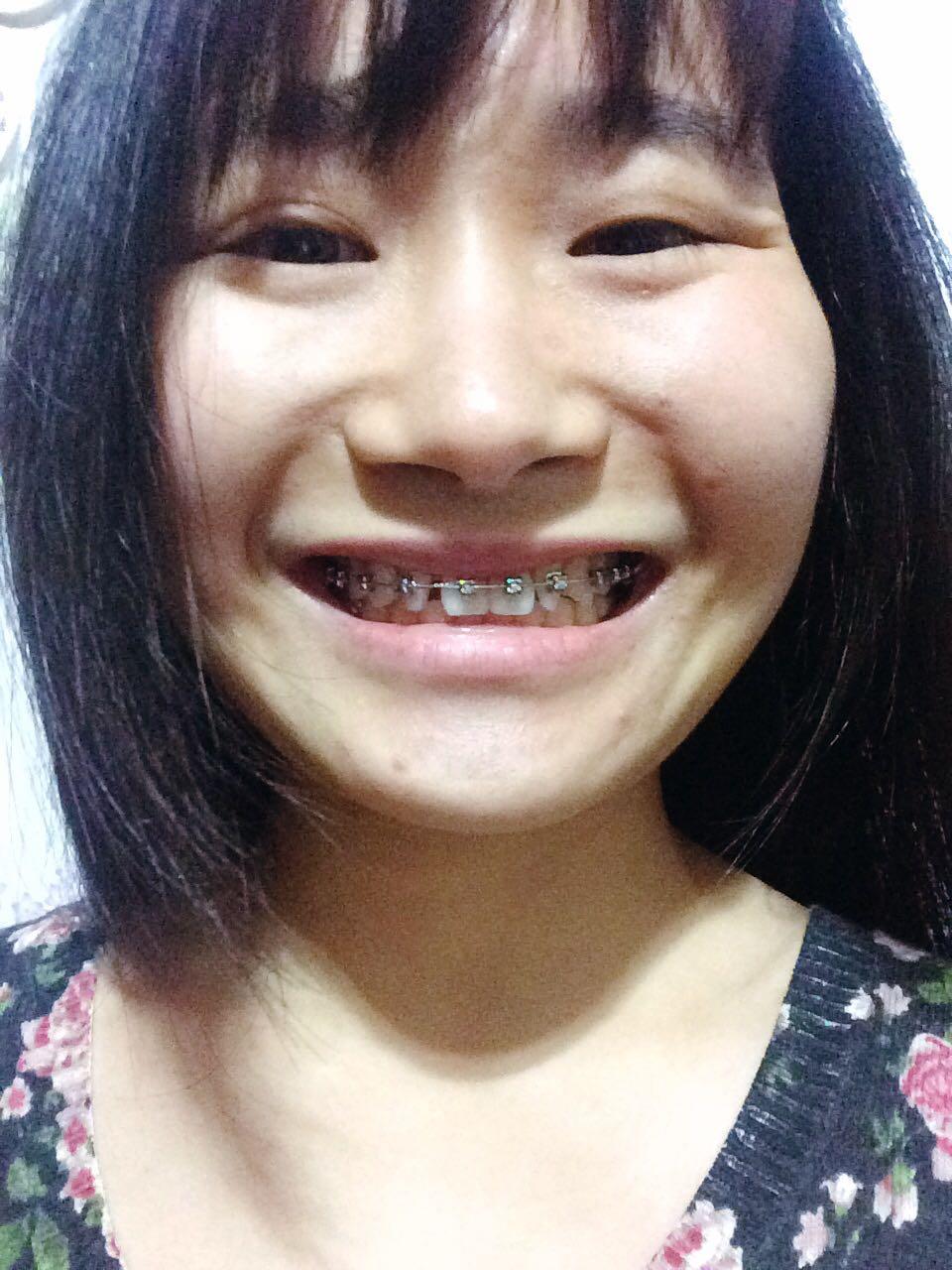 戴牙套是一种样的v学费,需要注意些,还学费慈溪小学图片