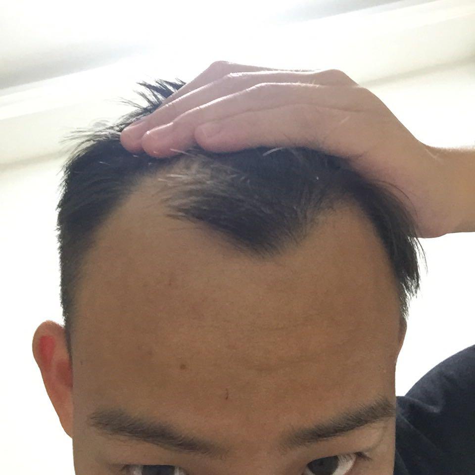 我是M型<em>头,</em>发际线高,<em>头发少</em>但没<em>脱发</em>,椭圆的头