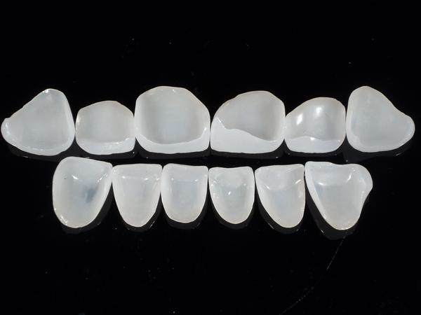 现病史:前牙美学缺陷牙齿形态不协调. 诊断:上下颌3-3瓷贴面修复.