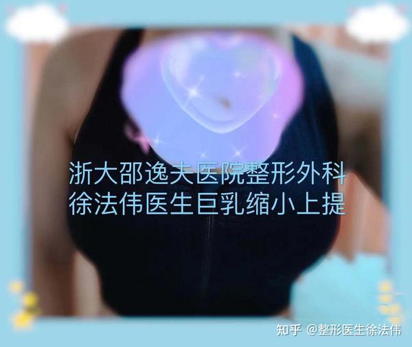 你适合做缩胸手术吗缩胸会影响哺乳吗会不会留疤