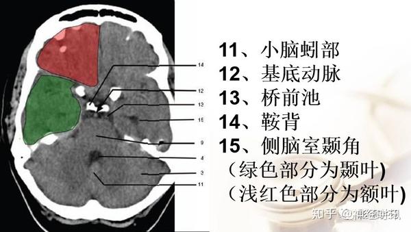 解剖&影像 ~ 脑实质ct断层解剖