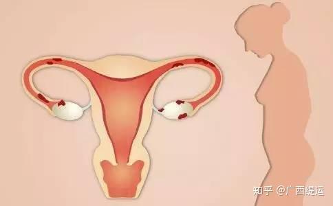 7,子宫内膜样瘤 :肿瘤表面光滑,常为单房,其内壁由一层极似子宫内膜