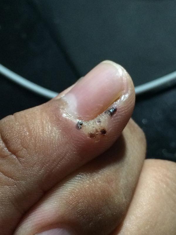 里面有黑刺,典型的跖疣特征 不要在用鸡眼膏了,鸡眼膏对跖疣是不起