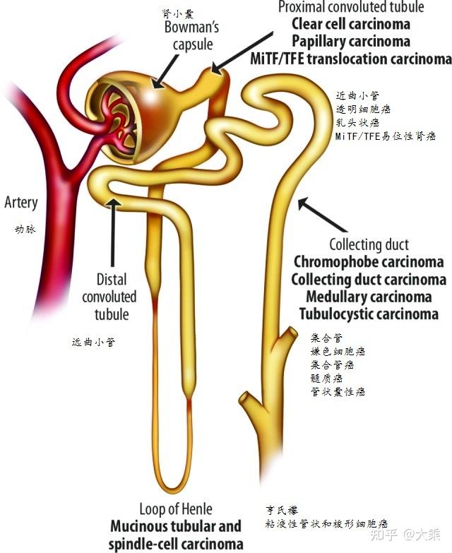 乳头状肾细胞癌(papillary  renal cell carcinoma)仅次于肾透明细胞