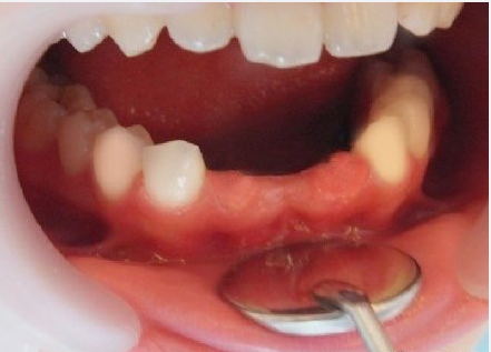 牙齿缺失后的三种修复方式牙博士首推最后一种