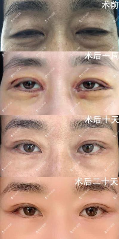 眼袋修复