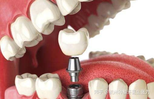 种植牙手术是一个较小的牙槽外科手术,类似拔牙,采用局部麻醉,创伤小