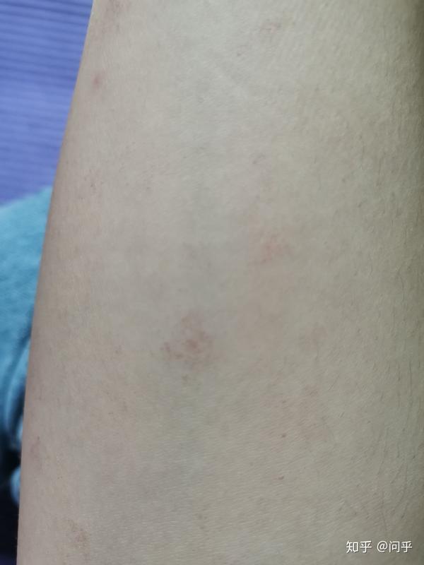 手臂上有很多小红点不痛不痒很多年了越长越多这是什么