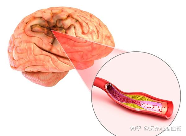 脑梗发作有致命风险 这4个信号早发现早治疗!