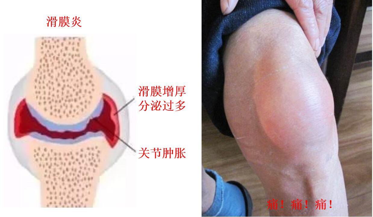 图02正常滑膜与滑膜炎的滑膜对比所谓滑膜炎,也就是人体的滑膜组织