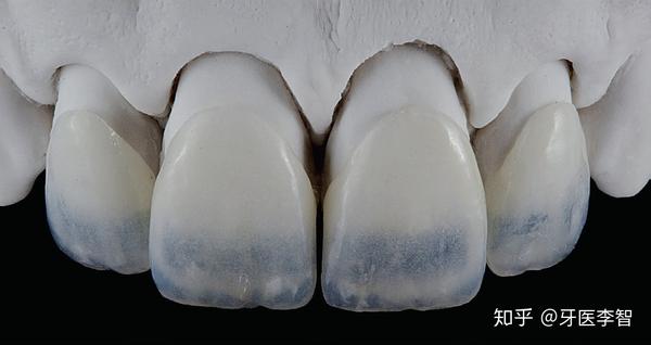 全瓷牙冠材料有什么不同,如何选择不同的陶瓷材料(1)