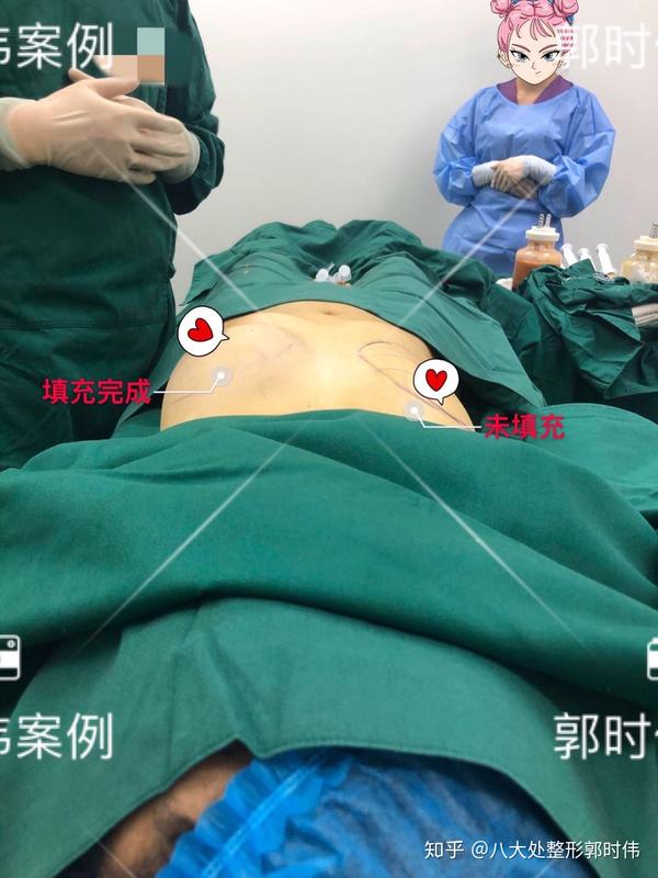 大腿环吸加自体脂肪隆胸(八大处郭时伟)系列案例二十八