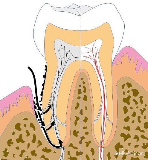牙周牙髓联合病变