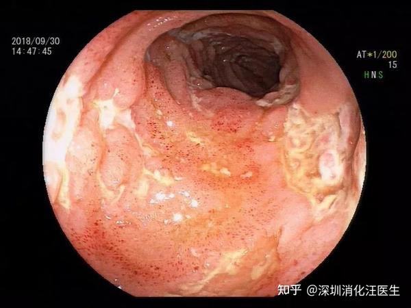 在王芳主任医师的建议下做肠镜,才被确诊为 「克罗恩病」