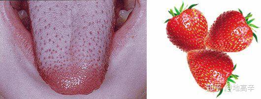             草莓舌