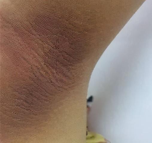 12岁小胖墩脖子突然变黑一查竟是糖尿病注意你或许有相同症状