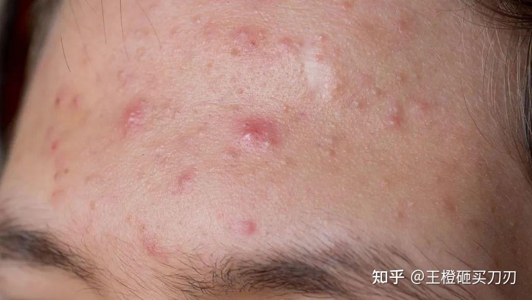 长势和阶段不同,痘痘也表现为以下4种形态:粉刺,炎性丘疹,脓包,结节