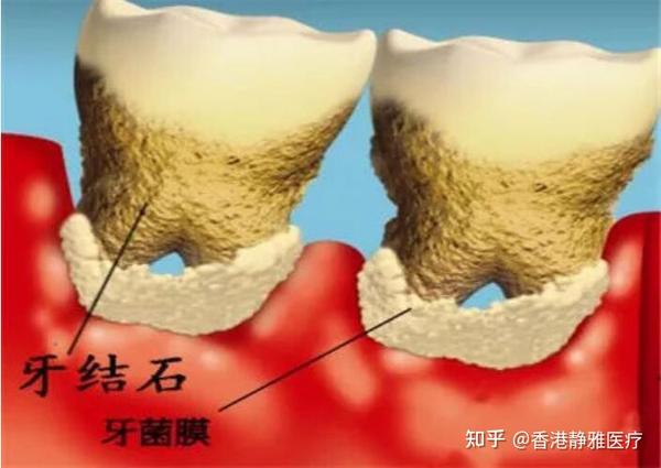 形成牙结石的原因有哪些