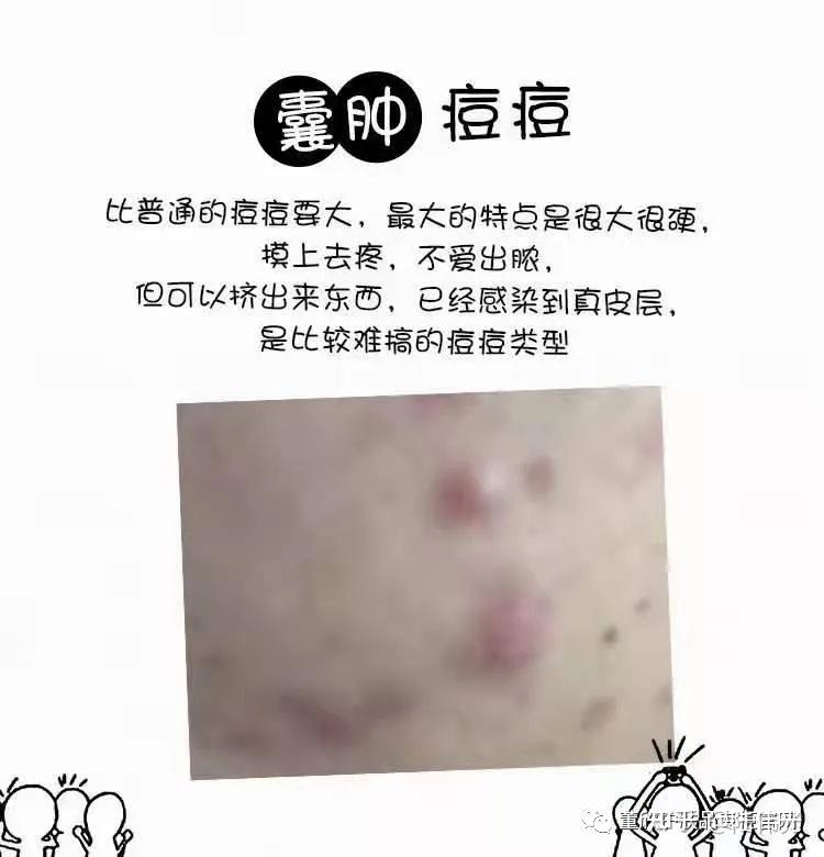 纯天然护肤品痘痘肌用什么董欣护肤品呢