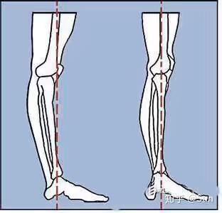 膝超伸对正常生活会有多大危害?