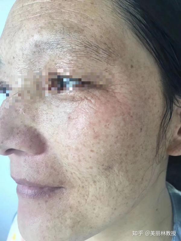 从层次来看雀斑长在表皮基底层 雀斑样痣的颜色更深,褐色或深褐色