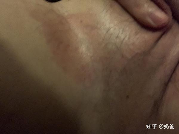 股癣的兄弟看过来,本人亲身体验