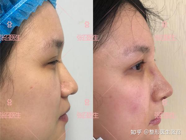 鼻尖下垂的治疗方法?