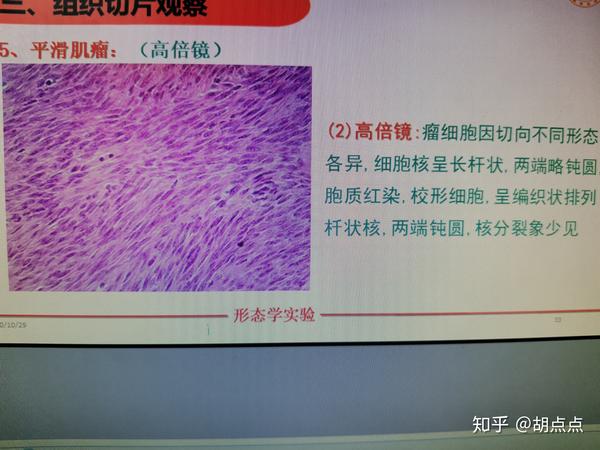 鳞状上皮乳头状瘤高分化鳞状细胞癌低分化鳞状细胞癌直肠腺癌平滑肌瘤