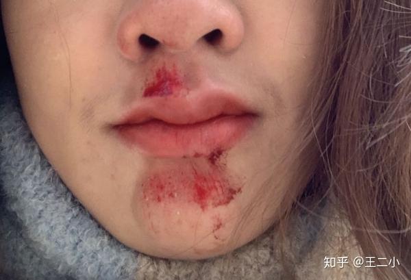 脸上擦伤恢复过程
