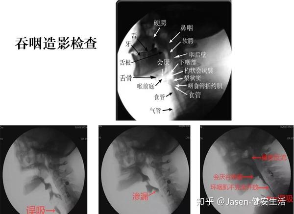 吞咽造影检查