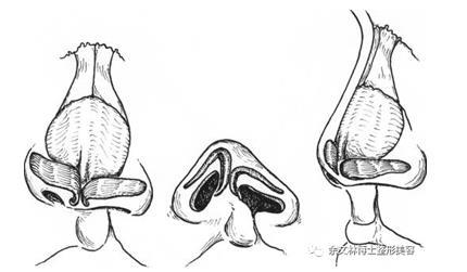 唇裂鼻子塌陷怎么修复1