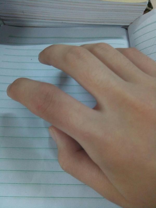冬天手冻了指节变粗了变形了怎么办