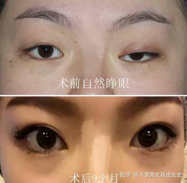 统一回复私信问题上睑下垂矫正案例