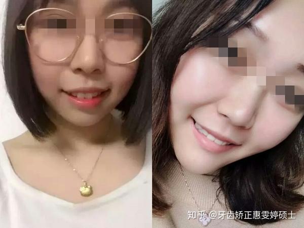 也是一位21岁的小女孩,牙齿症状:门牙前突,侧面无下巴.